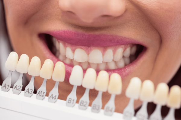 Teeth Whitening in Malaysia: Unlocking the Secret to a Radiant Smile